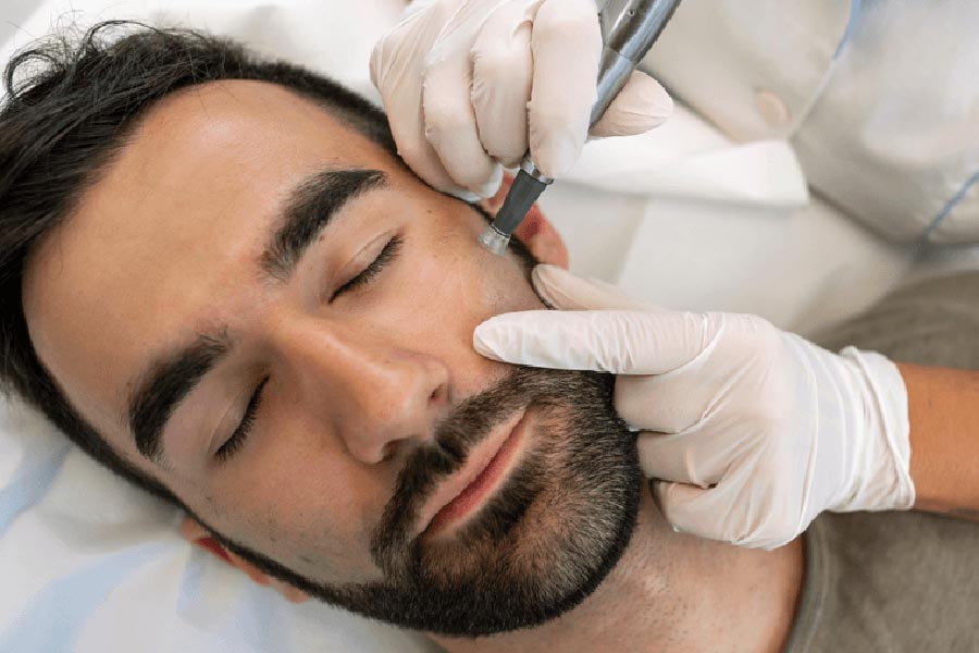 Nahaufnahme Gesicht eines Mannes der eine Microneedling-Behandlung bekommt